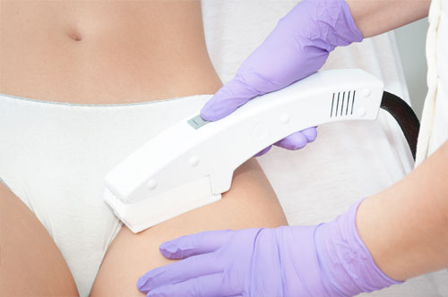 APL hair removal for high bikini line inc very top of the leg