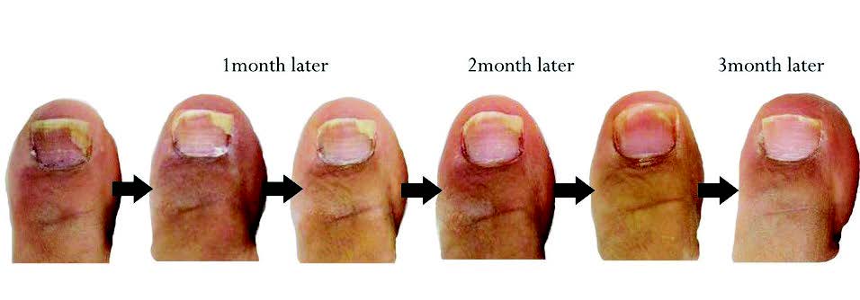 Onychomycosis Fungal Laser Treatment