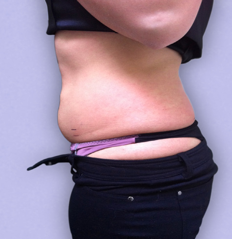 Cavitation Lipo