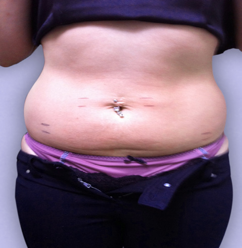 Cavitation Lipo