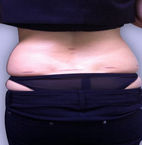 Cavitation Lipo