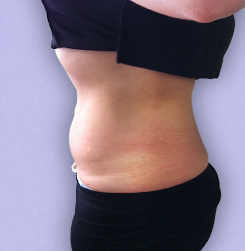 Cavitation Lipo