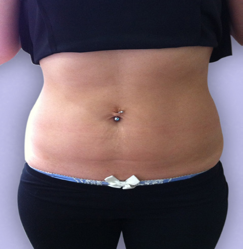 Cavitation Lipo