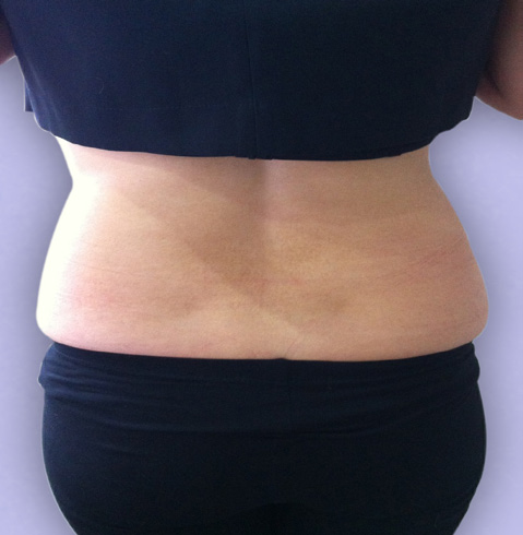 Cavitation Lipo