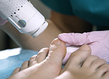 Onychomycosis treatment in Norwich